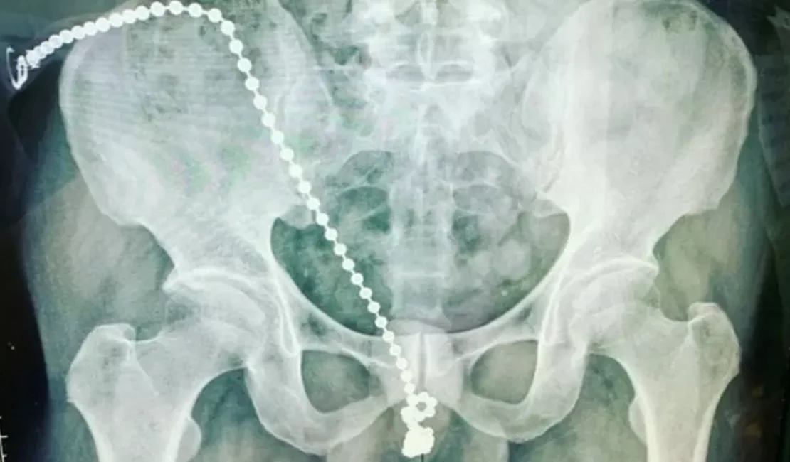 Homem passa por procedimento cirúrgico após introduzir bolinhas do prazer no pênis