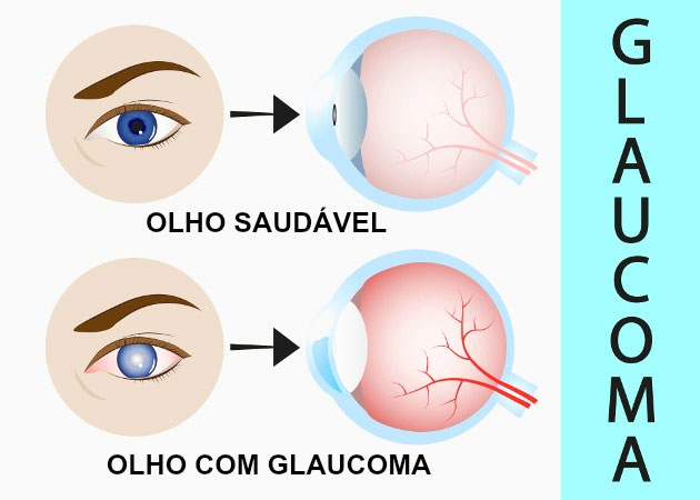 No mês do combate ao Glaucoma, população terá atendimento gratuito