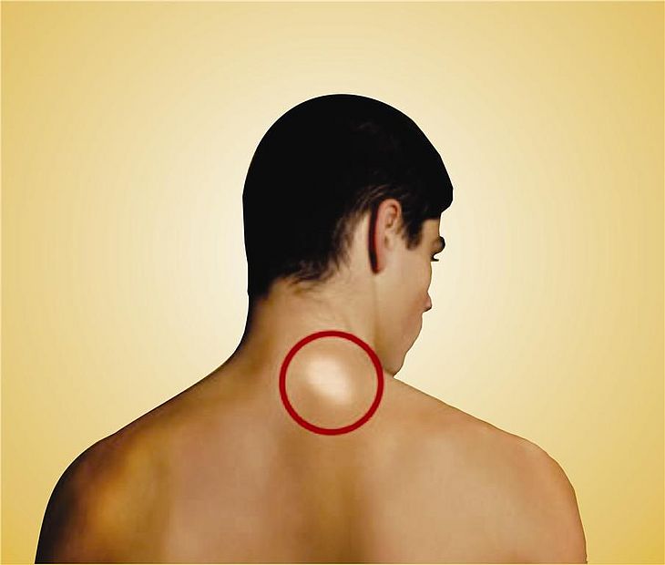 Em Alagoas, 334 novos casos de hanseníase ocorreram em 2018