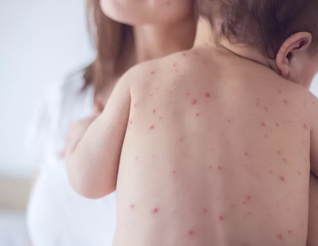 São Paulo reforça campanha de vacinação contra o sarampo após novos casos
