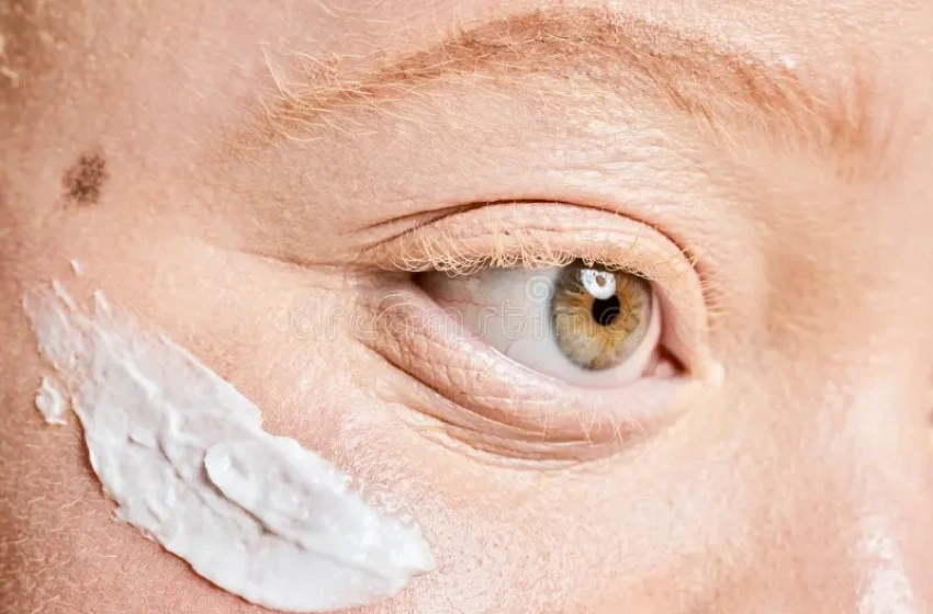 Pessoas com albinismo têm acesso gratuito a protetor solar em Maceió