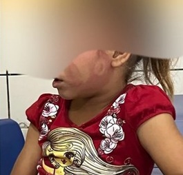 Homem é preso por agredir filha de 6 anos em Taquarana; criança foi encontrada com hematoma no rosto