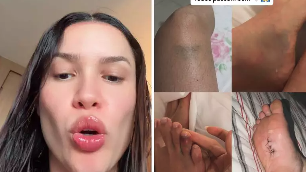 Juliette mostra hematomas após despedida de solteira: “Fim do mundo”