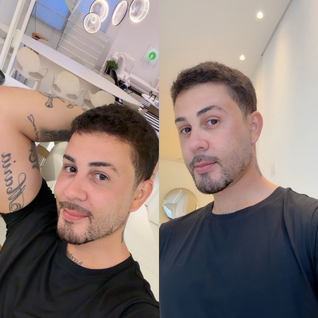 Carlinhos Maia revela cirurgia estética após sumiço das redes; confira