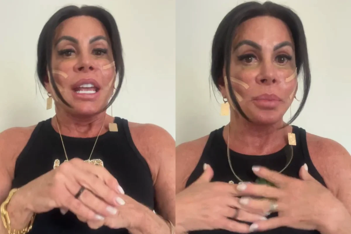 Gretchen revela novo procedimento com fios de sustentação no rosto