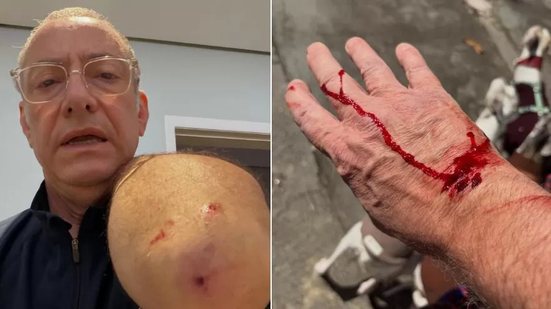 Jornalista da Globo leva 4 pontos na mão após ataque de Pitbull sem guia