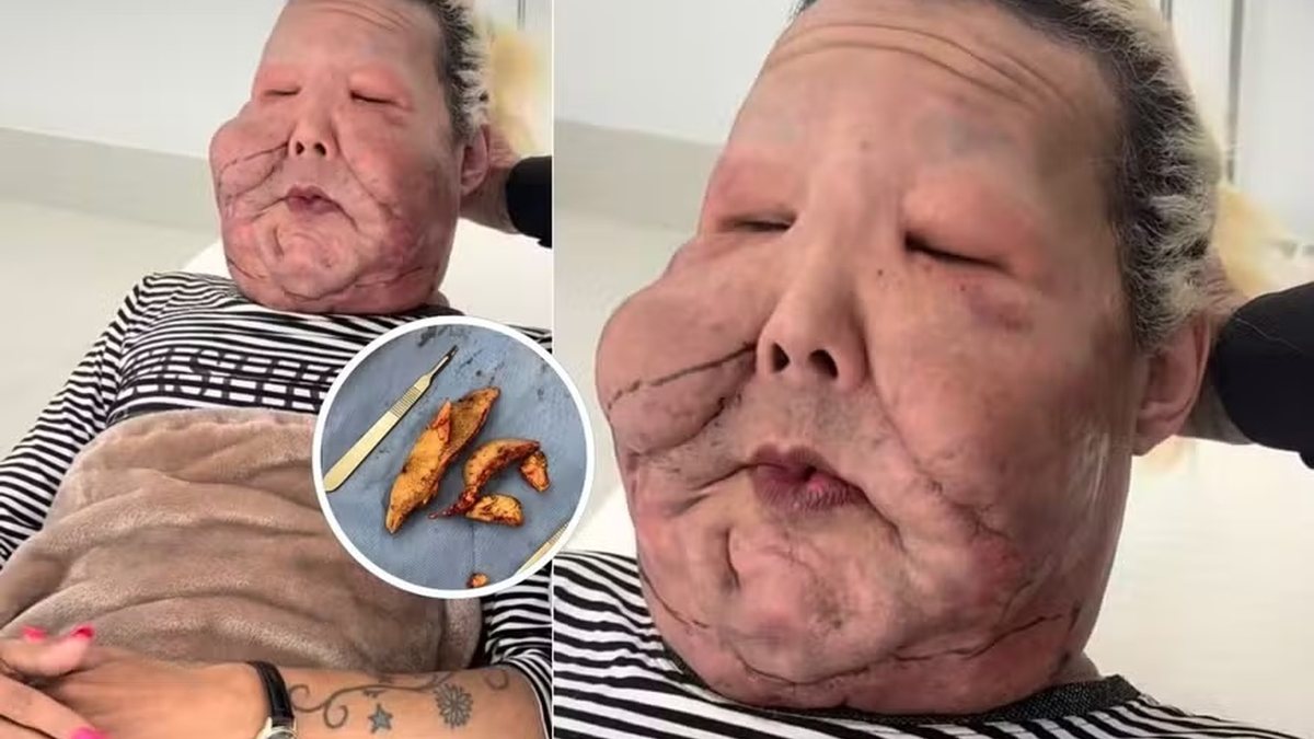 Juju do Pix passa por nova cirurgia para retirada de óleo mineral do rosto