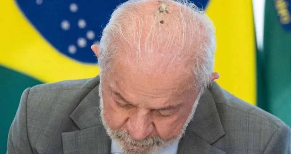 Lula passa por novas sessões de radioterapia no couro cabeludo