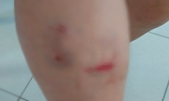 Pai chama a polícia depois de ser mordido pelo próprio filho na Chã do Pilar