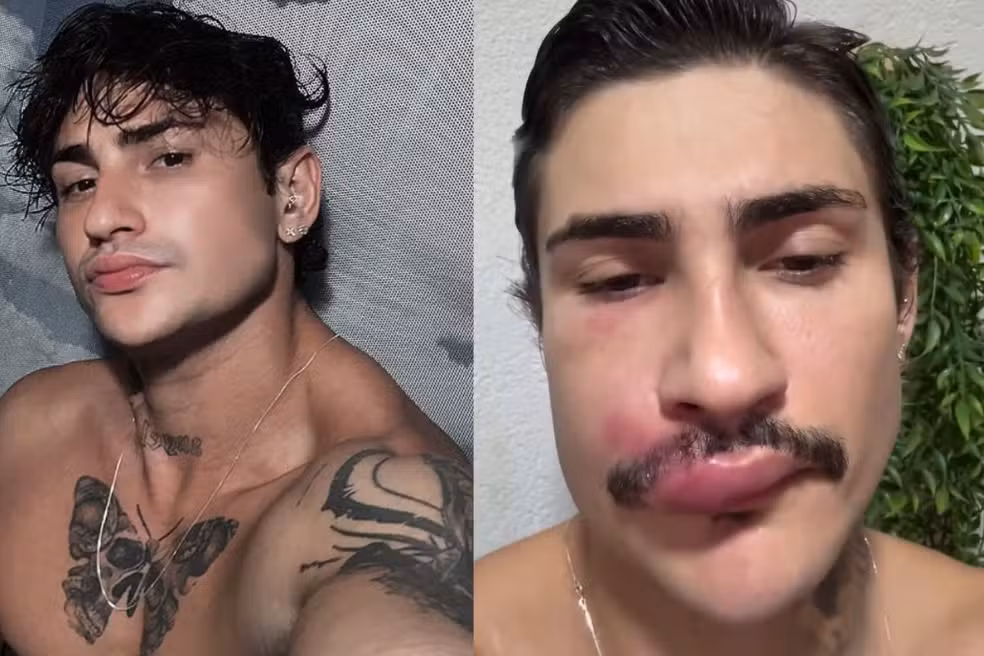 'Ken de CG' sofre infecção grave após espremer espinha e faz alerta aos fãs
