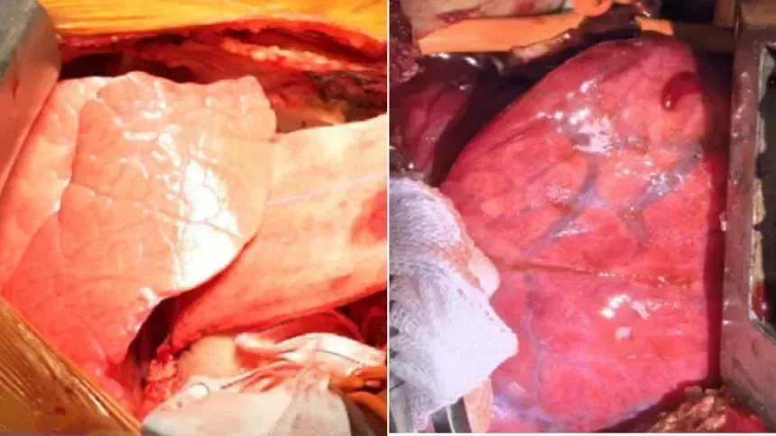 Pulmão de porco modificado é transplantado em homem pela 1ª vez