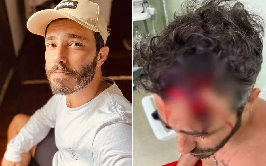 Ator tem parte do couro cabeludo arrancada ao ser espancado durante assalto