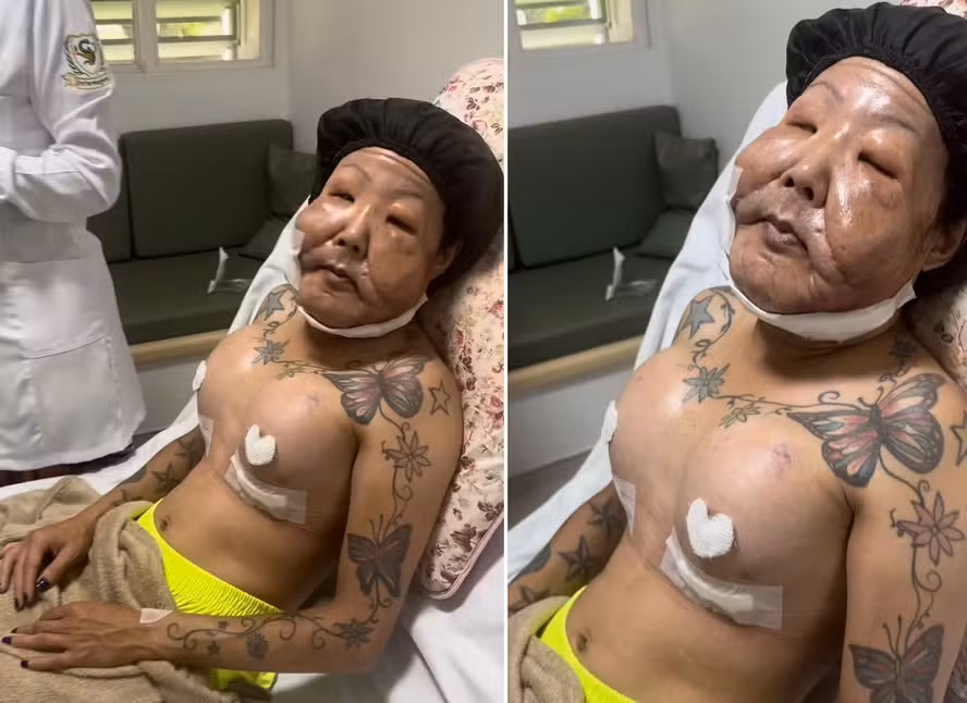 Juju do Pix comemora prótese de silicone de 550 ml nos seios