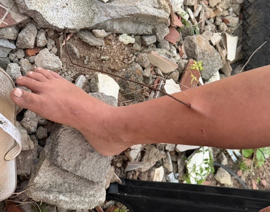 Criança tem perna perfurada por vergalhão em terreno baldio de Arapiraca